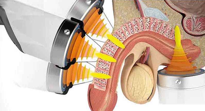 Shock Wave Therapy Toronto